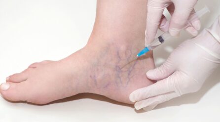 The future of spider vein treatment